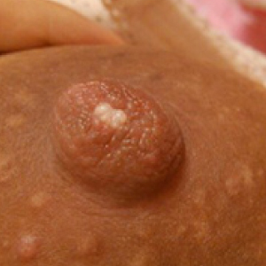 護理師教學 乳頭小白點10大處理方法 哺乳塞奶 乳腺阻塞不再來 亞尼活力 護理師教學 乳頭小白點10大處理方法 哺乳塞奶 乳腺阻塞不再來 亞尼活力