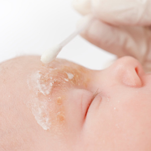 【破解迷思】哺乳媽媽飲食會造成母乳寶寶脂漏性皮膚炎嗎?