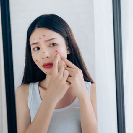 【痘痘位置圖解】臉頰額頭下巴長痘原因與內分泌失調一次看懂