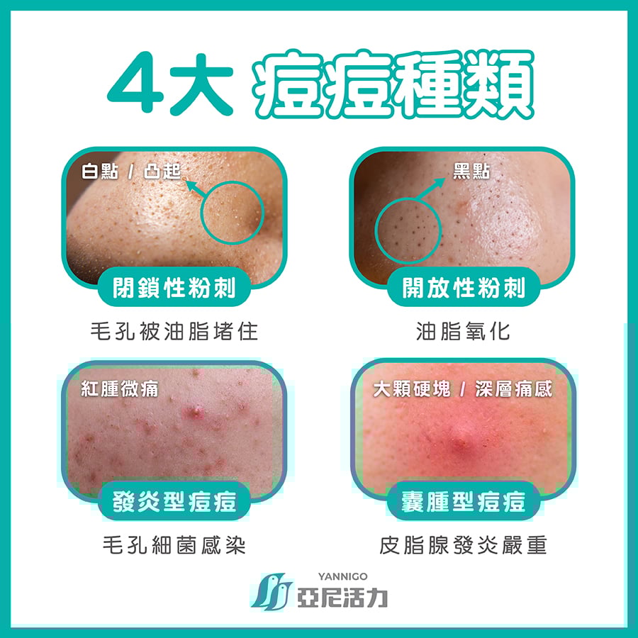 4大痘痘種類 閉鎖性粉刺 開放性粉刺 發炎型痘痘 囊腫型痘痘