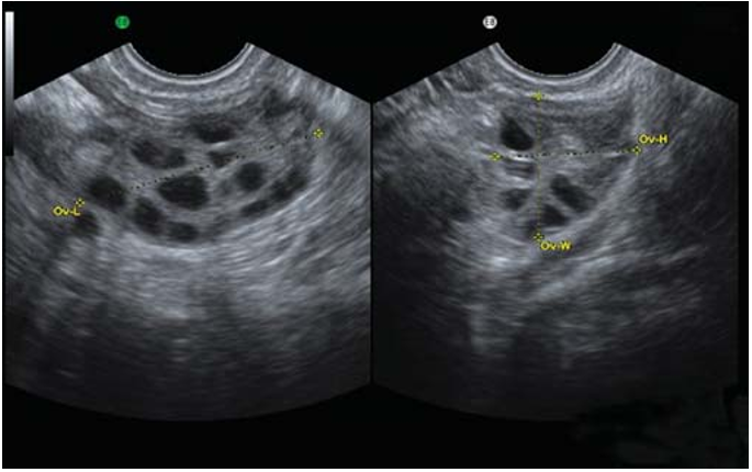 多囊性卵巢症候群卵泡