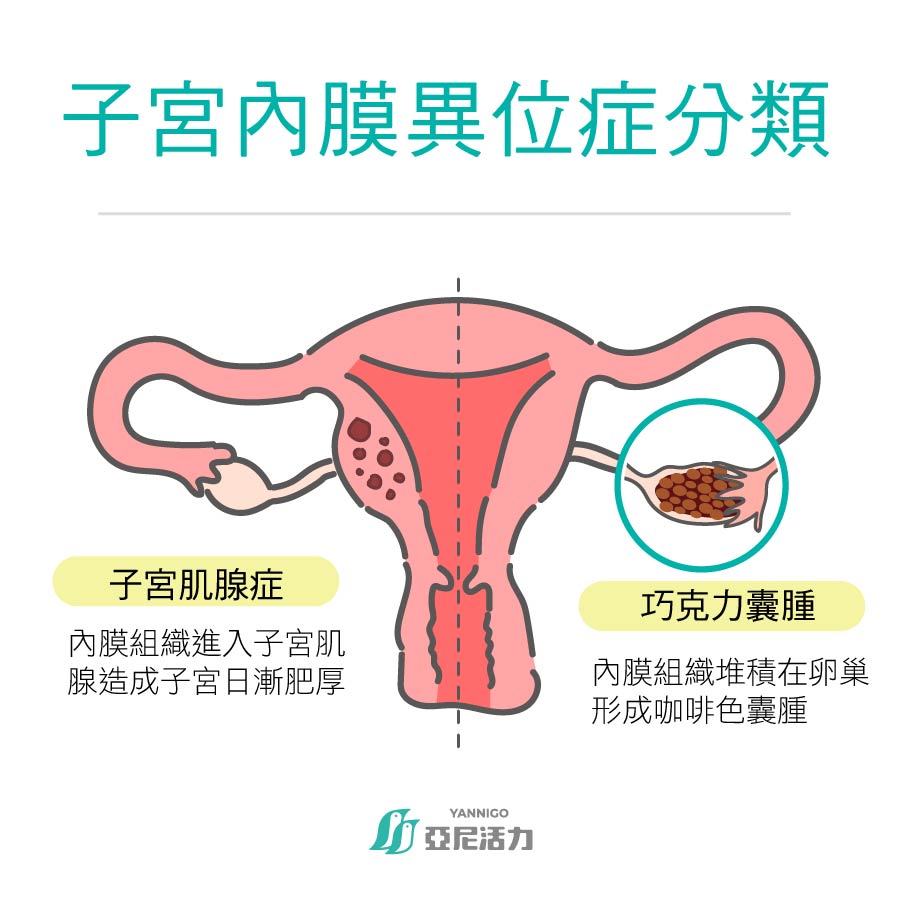 子宮內膜異位症分為子宮肌腺症與巧克力囊腫