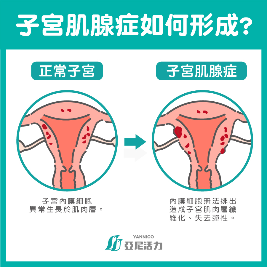 子宮肌腺症如何形成