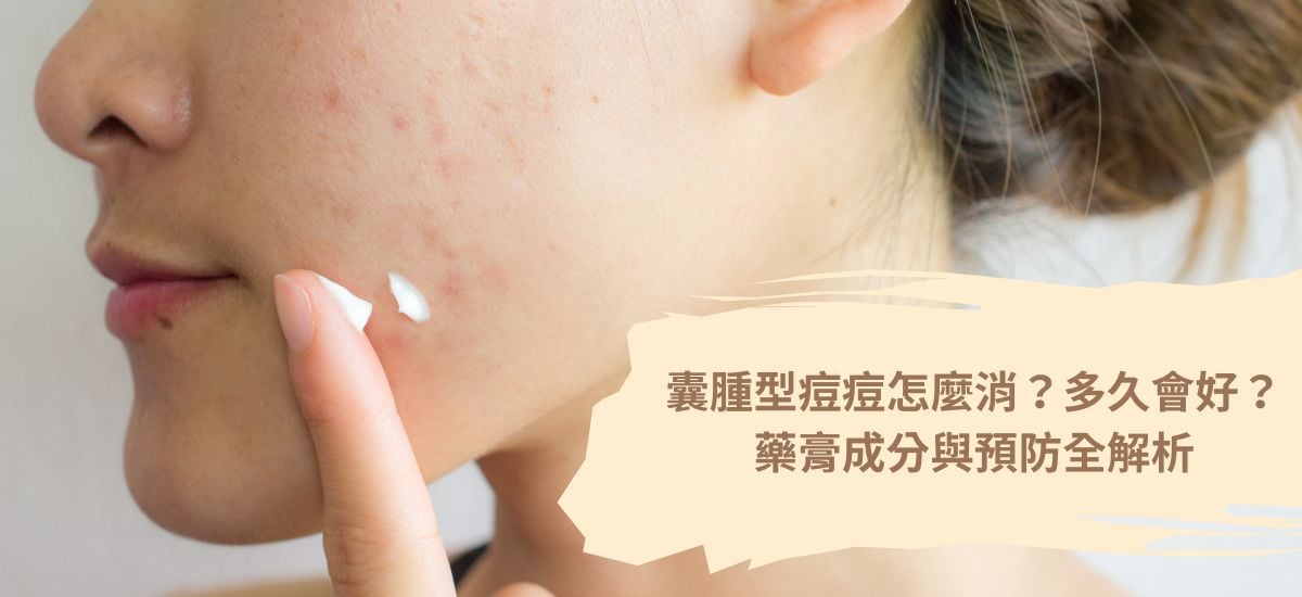 囊腫型痘痘怎麼消？多久會好？藥膏成分與預防全解析