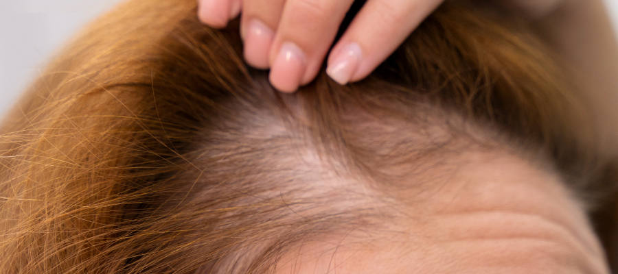 女性、更年期掉髮原因有哪些？